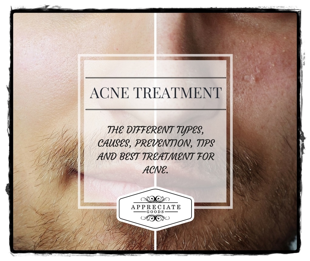 Top 3 Most Effective Acne Treatments